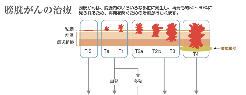 膀胱がんの治療