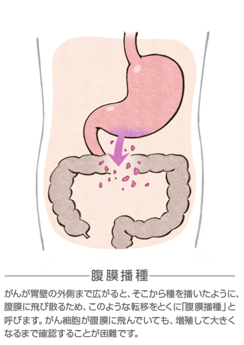 スキルス胃がん