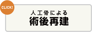 人工骨による術後再建